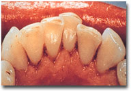 зубы после обработки